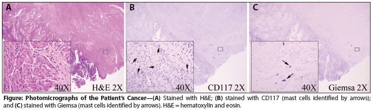 Improved Metastatic Uterine Papillary Serous Cancer Outcome With Treatment of Mast Cell Activation Syndrome