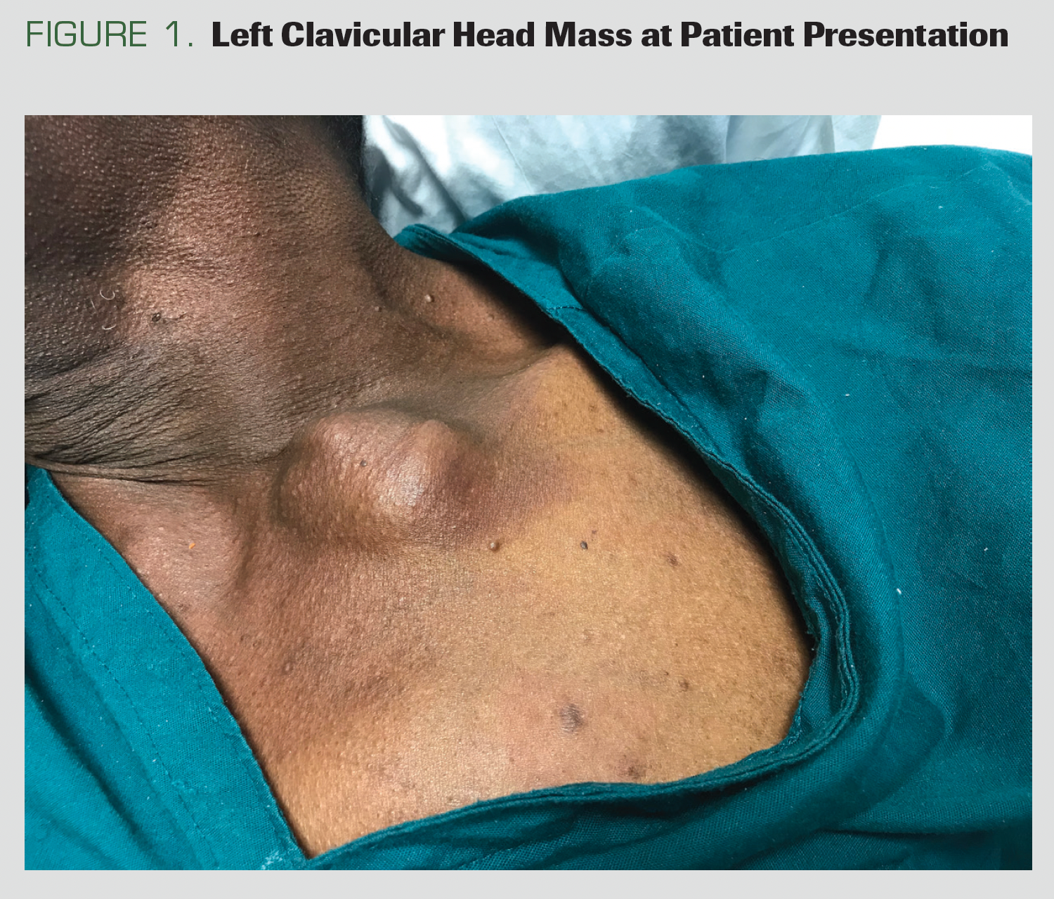 Figure 1. Left Clavicular Head Mass at Patient Presentation