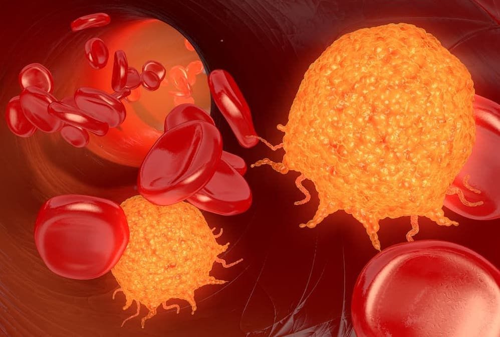 Manageable Anemia Achieved With Magrolimab Plus Azacitidine in High-Risk MDS/AML