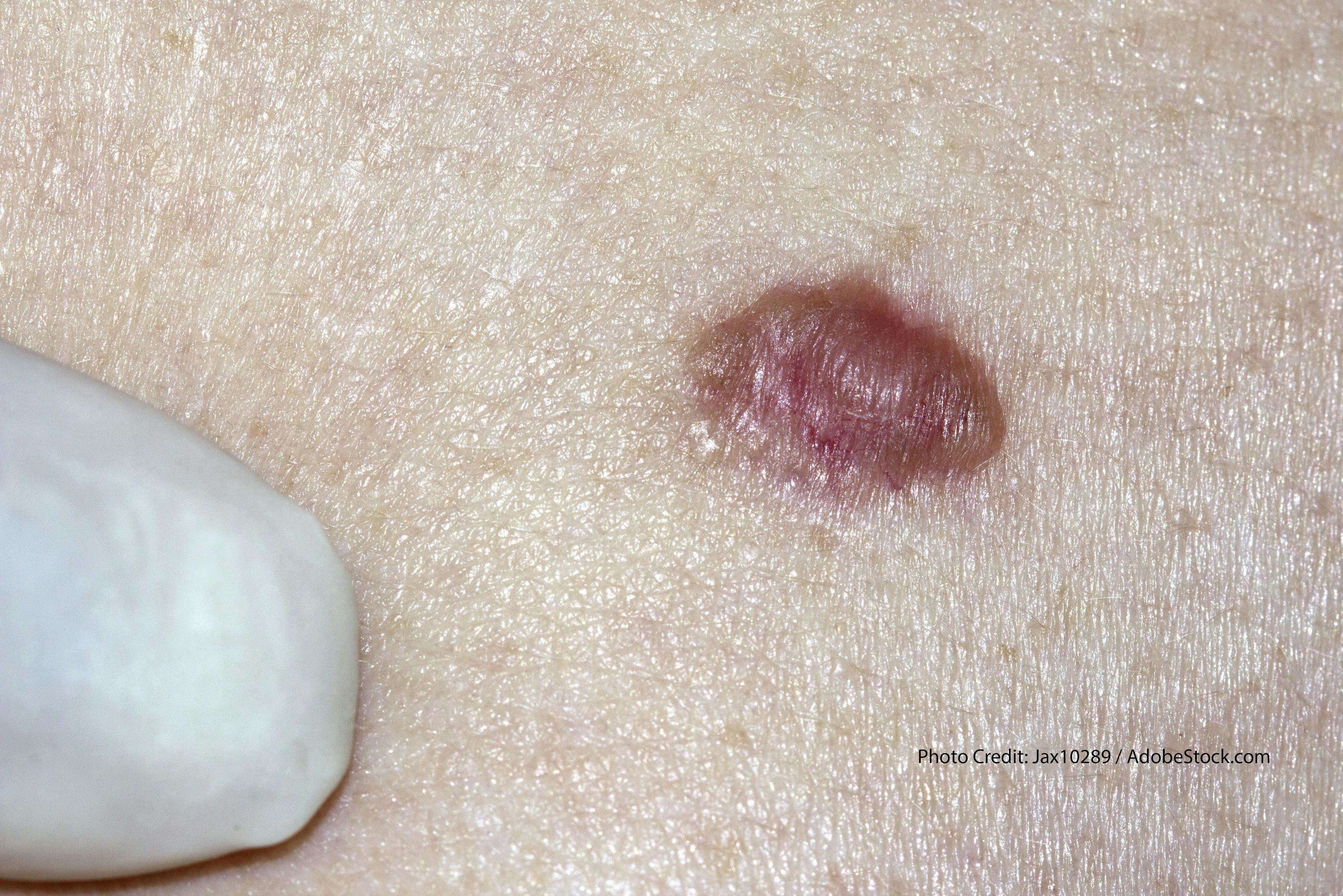 Study: Best Treatments for Basal Cell Carcinoma