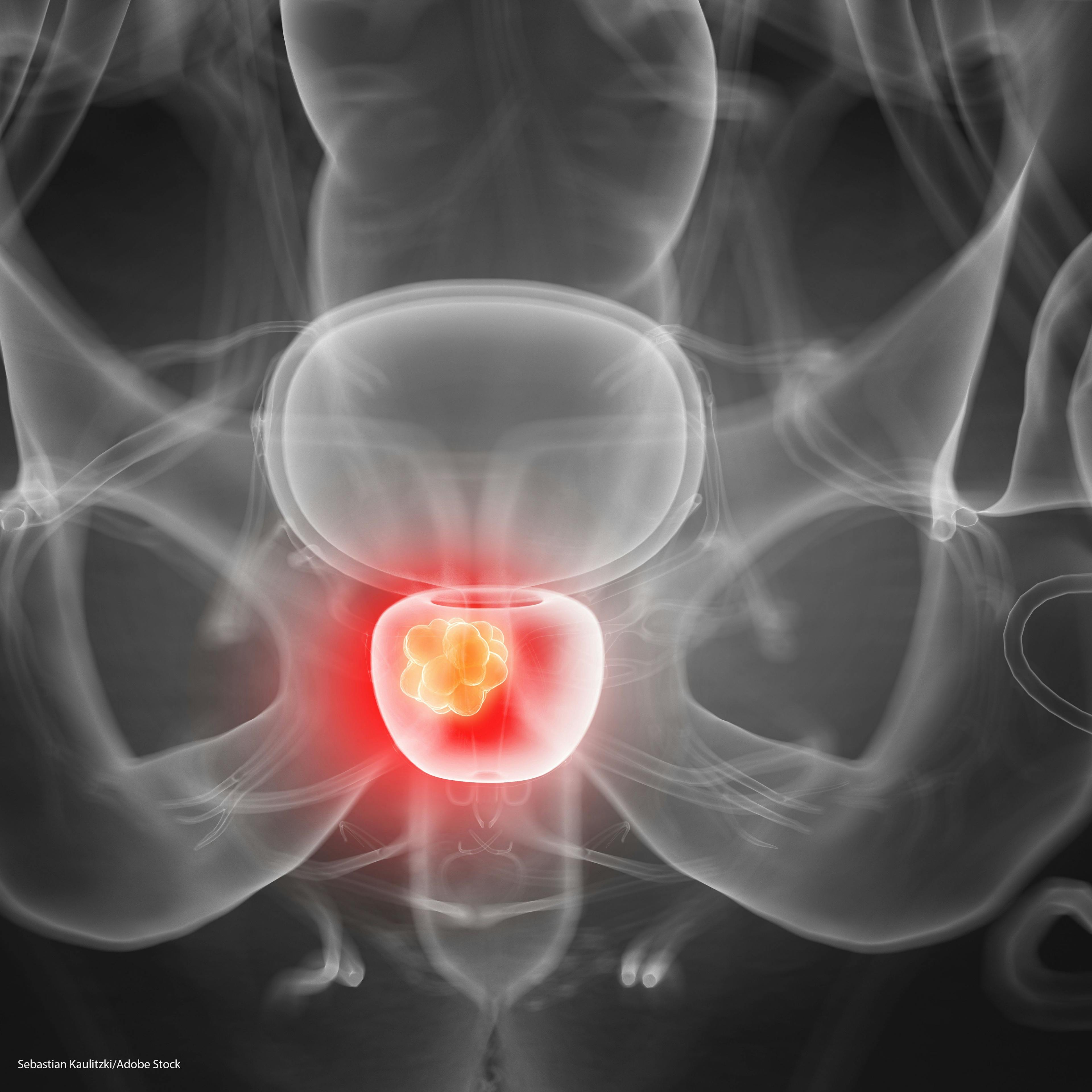 Apalutimide Plus ADT Improves Survival in Nonmetastatic Castration-Resistant Prostate Cancer