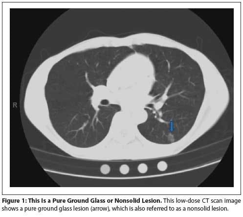 Low-Dose Spiral CT Screening and Evaluation of the Solitary Pulmonary Nodule  