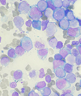 Myeloblasts with Auer rods seen in AML