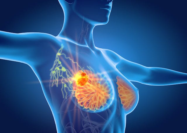 Overall survival after 10 years appears to be comparable regardless of whether patients 65 years or older received irradiation following surgery for low-risk, hormone receptor–positive breast cancer.