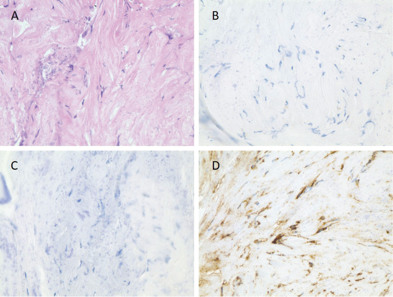 Erdheim-Chester Disease: A Case Report of BRAF V600E–Negative, MAP2K1-Positive ECD Diagnosed by Blood Next-Generation Sequencing Assay and a Brief Literature Review