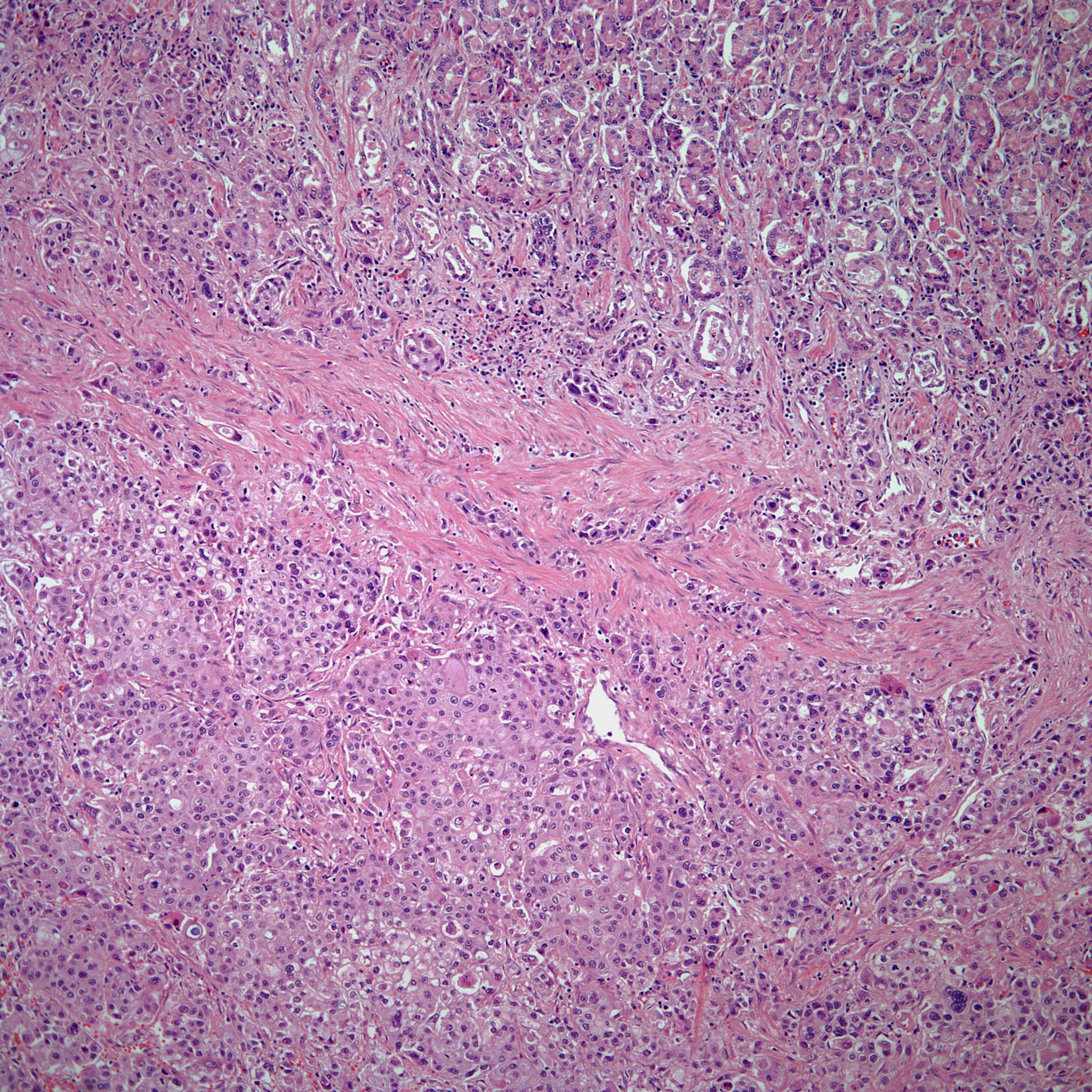 A 59-Year-Old Male With Abdominal Pain, Gastric Mass