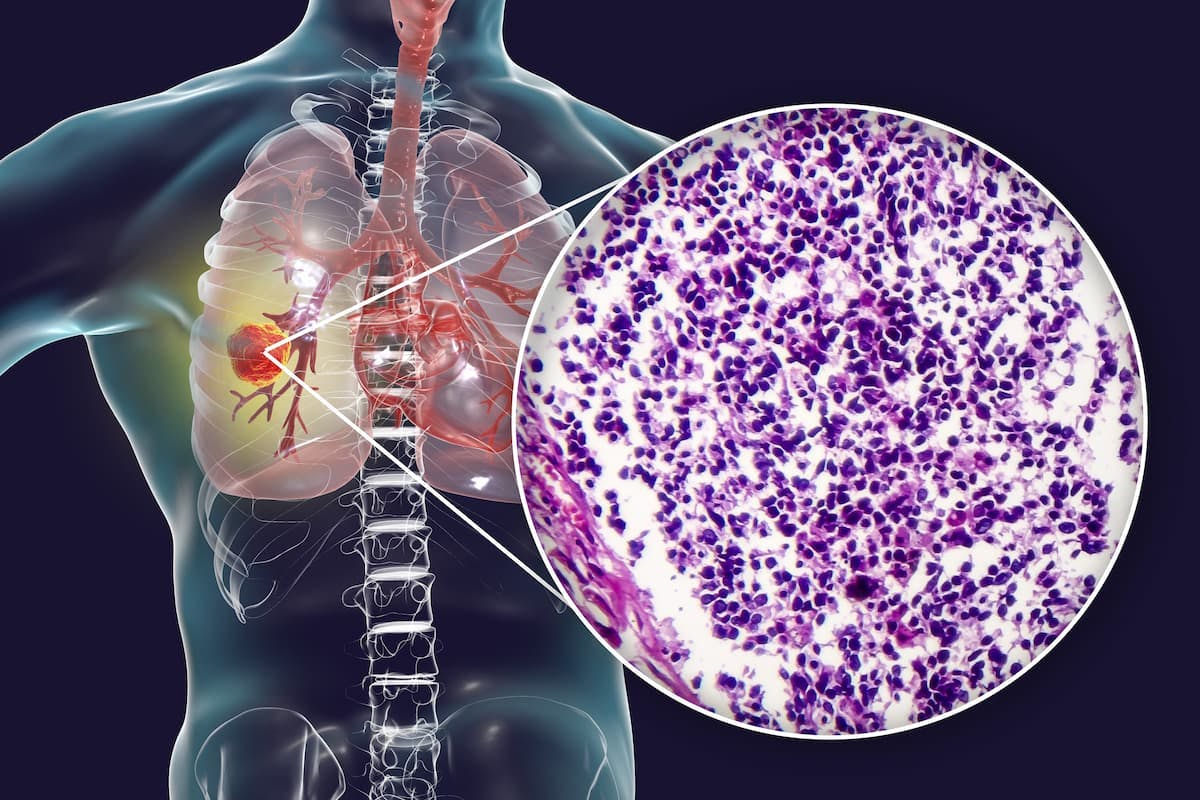 Findings of the phase 2 PERLA trial indicated that dostarlimab combined with chemotherapy achieved promising responses in patients with metastatic non-squamous non-small cell lung cancer.