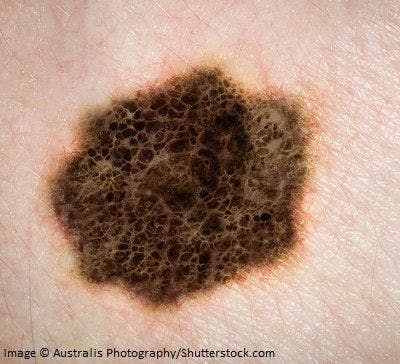 Adding Localized Therapy to Ipilimumab Boosts Survival in Melanoma