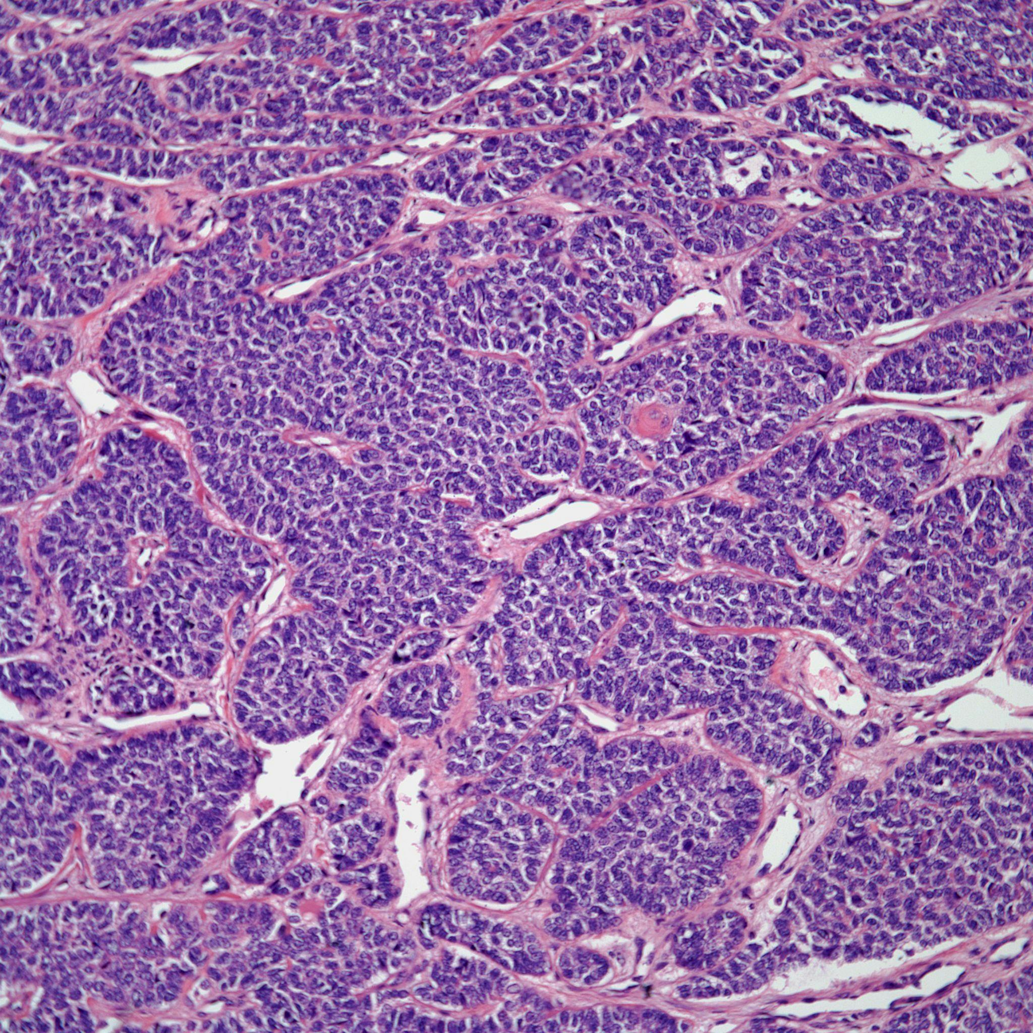 A 45-Year-Old With a Thyroid Gland Mass