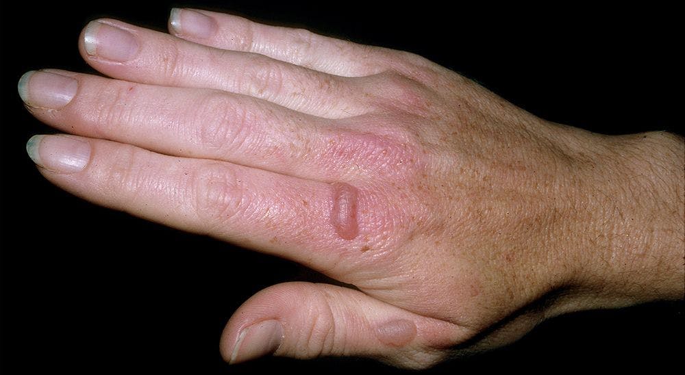 A 61-Year-Old Caucasian Woman Presents With History of “Bizarre Insect Bites”