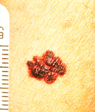 Immunotherapy Combination Active in Advanced Melanoma