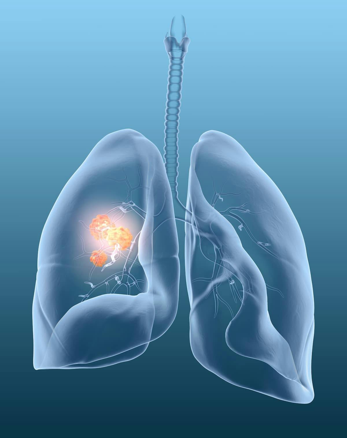 Sexual Dysfunction Poses Significant Issue for Women With Lung Cancer