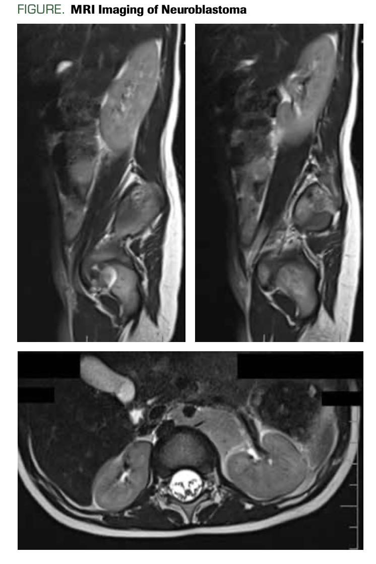 FIGURE. MRI Imaging of Neuroblastoma