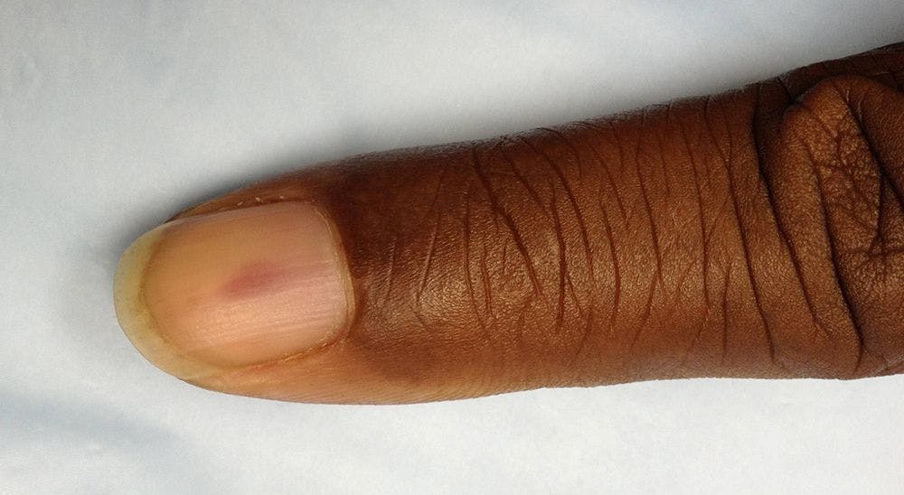 A 49-Year-Old Woman Notes the Onset of a Painful Reddish-Blue Discoloration Under One Fingernail