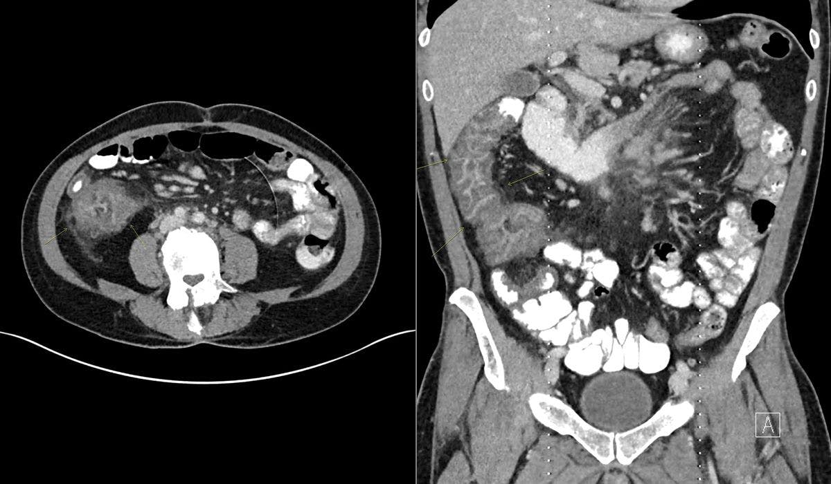 Neutropenia and Abdominal Pain in a 30-Year-Old Patient