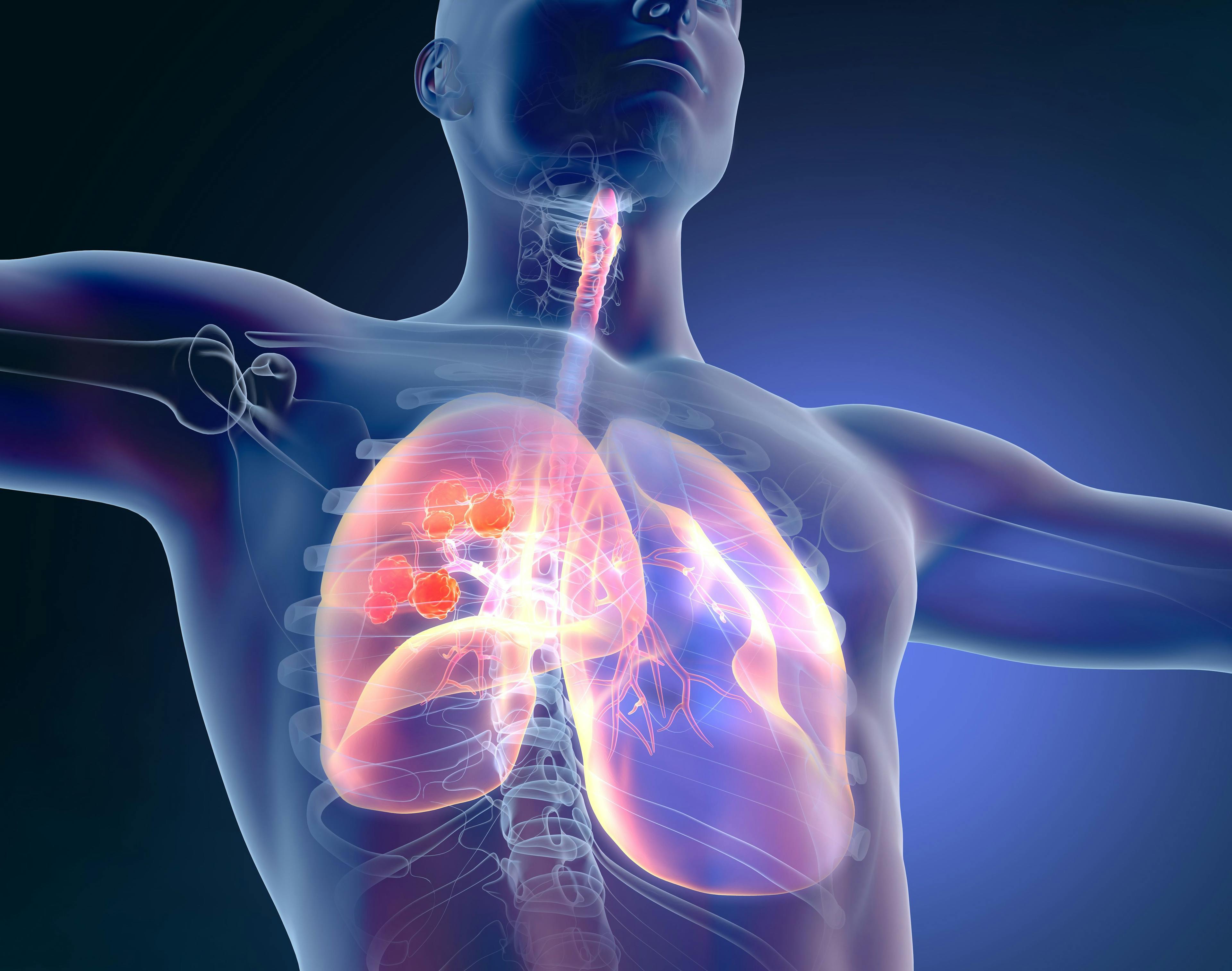Findings from the phase 3 CheckMate 743 trial indicated that patients with unresectable malignant pleural mesothelioma derived a continued overall survival benefit after being treated with nivolumab and ipilimumab.