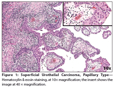 Lymphoepithelioma-Like Carcinoma of the Urinary Bladder