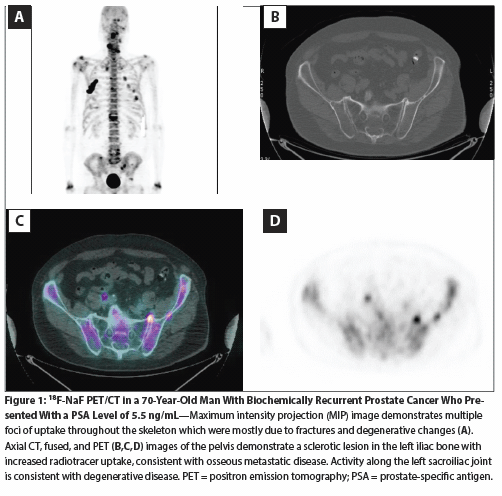 (18)F-NaF PET/CT and (11)C-Choline PET/CT for the Initial Detection of Metastatic Disease in Prostate Cancer: Overview and Potential Utilization