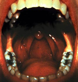 Soft palate and oropharyngeal tissues