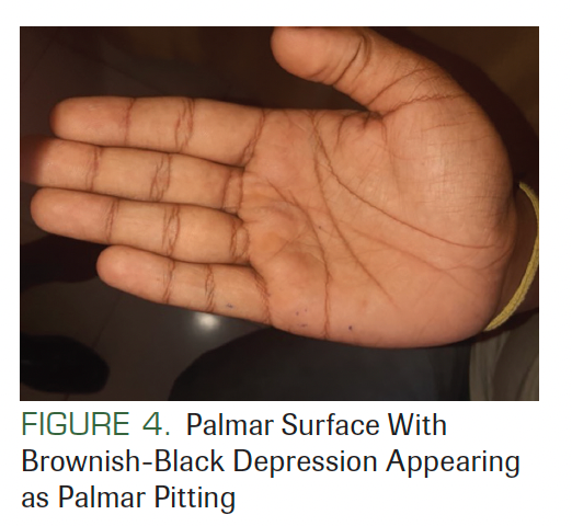 FIGURE 4. Palmar Surface With Brownish-Black Depression Appearing as Palmar Pitting
