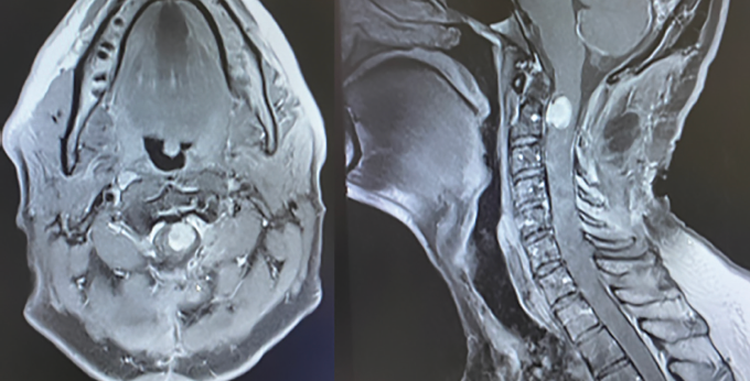 Spinal ATRT and Radiotherapy Case Report in an Adult Man