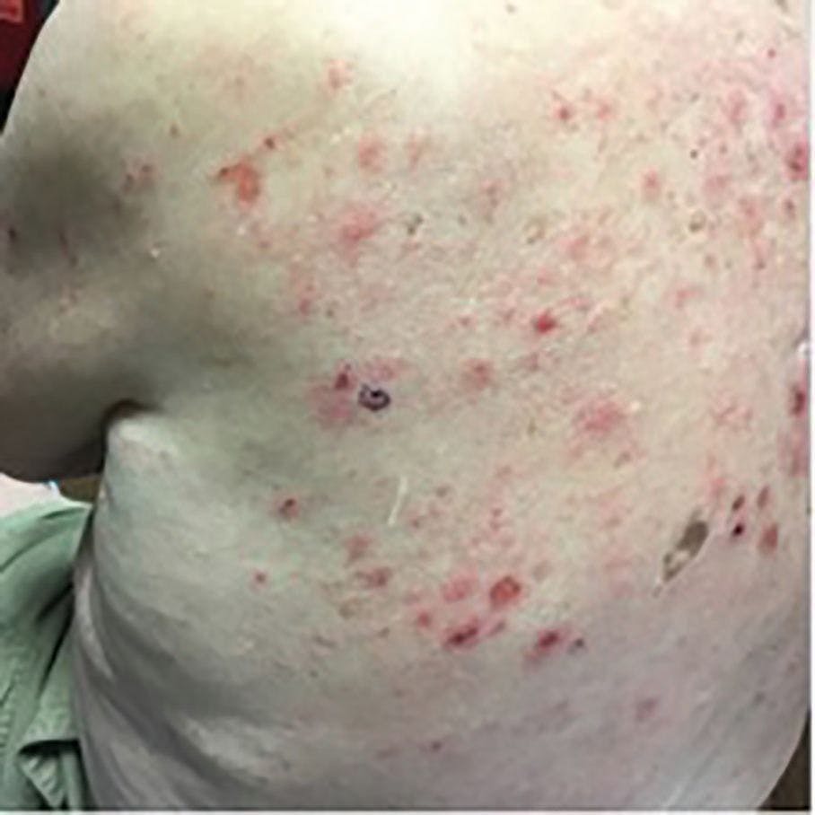 A 79-Year-Old Man on Nivolumab with Itchy Erythematous Patches