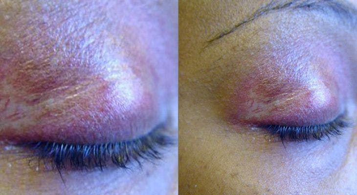A 46-Year-Old Woman Presents With Difficulty in Ambulation, and Swelling and Discoloration of Both Eyelids