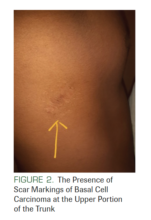 FIGURE 2. The Presence of Scar Markings of Basal Cell Carcinoma at the Upper Portion of the Trunk