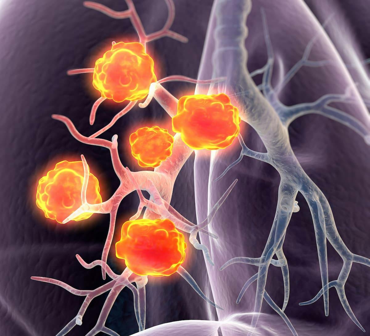 DFS Benefit Noted Across Patient Subgroups for Adjuvant Atezolizumab in Early-Stage NSCLC