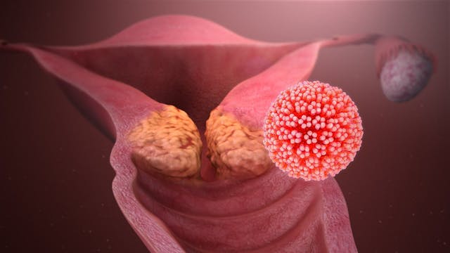 Tiragolumab Plus Atezolizumab Will Not Be Pursued in Further Cervical Cancer Management