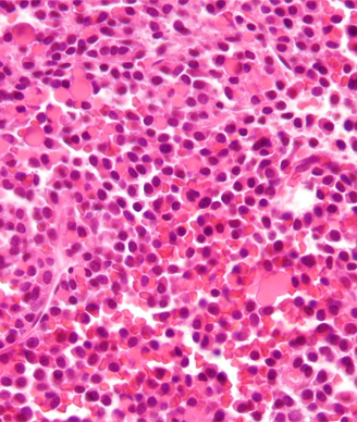 Micrograph of a plasmacytoma