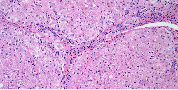 Liver Nodule Found in 35-Year-Old Woman