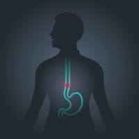 Trimodality Therapy Leads to QOL Improvement in Esophageal Cancer 