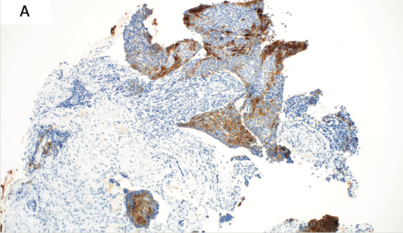 FIGURE 3. Histopathologic Features of Subsequent Metastases

(A) Ber-EP4 positivity within the lung mass confirms a diagnosis of metastatic basal cell carcinoma (Ber-EP4 immunostain, original magnification × 100).