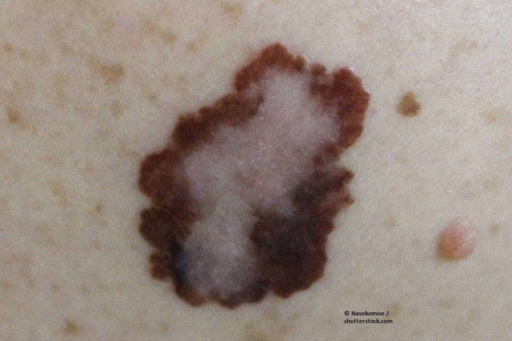 Can Bevacizumab Be Recommended in High-Risk Melanoma?