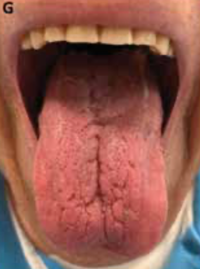 FIGURE 1. Dry Mouth Before Systemic Steroids Course Improvement in saliva production after systemic steroid course (G).