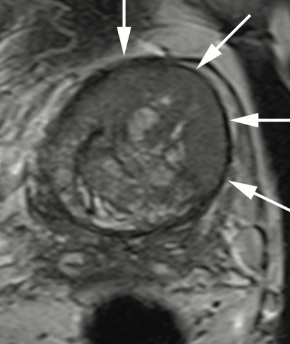 Successful Diagnosis and Treatment of Occult Prostate Cancer Despite Multiple Negative Prostate Biopsies and Negative Prostate MRIs