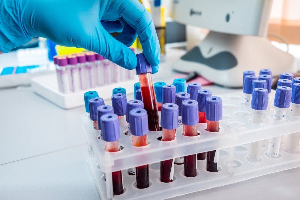 UK Researchers Develop Blood Test for Breast Cancer Diagnosis
