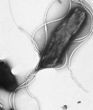 Eradicating H pylori Could Help Prevent Gastric Cancer in Asians