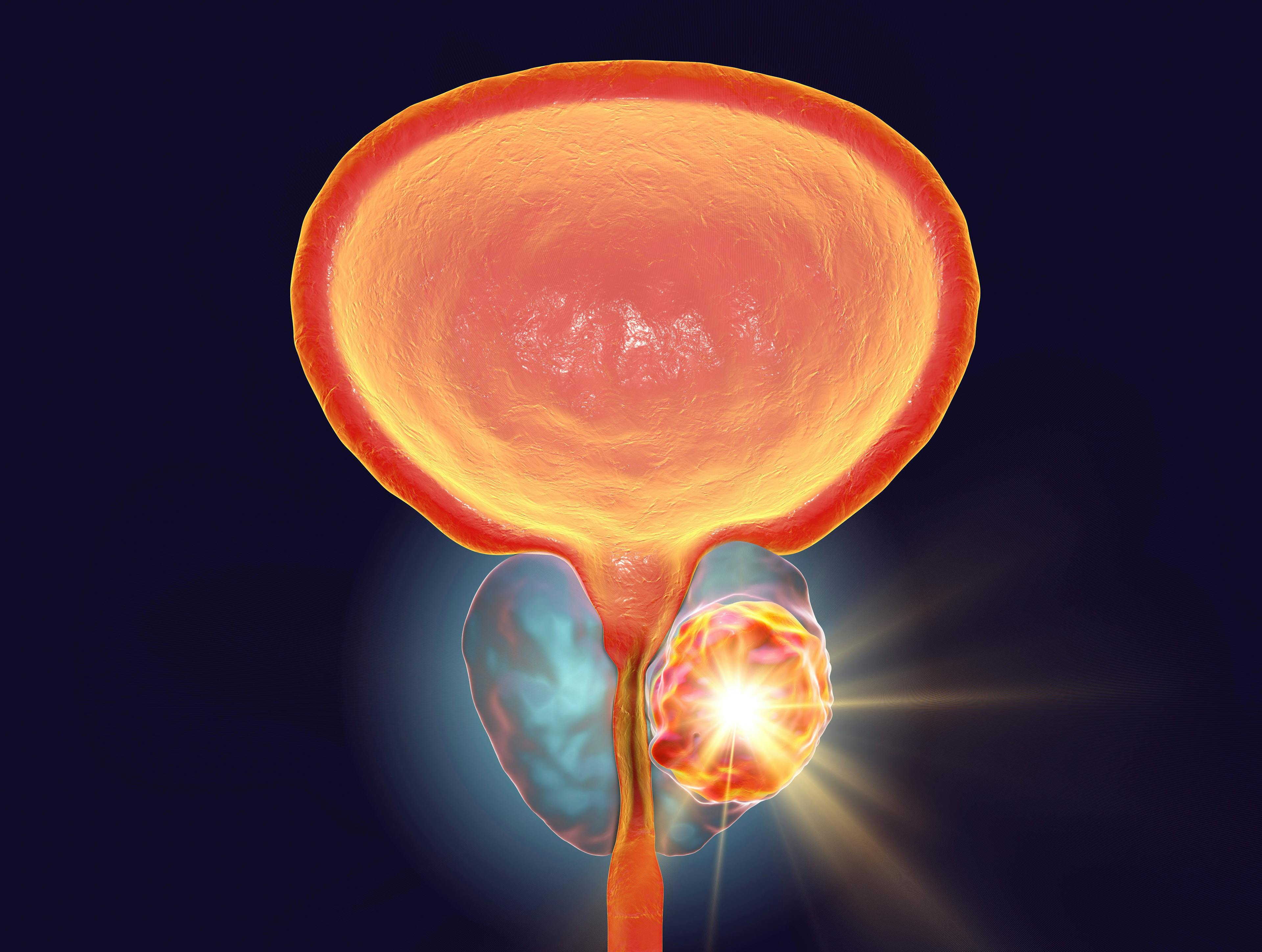 Results from the phase 2a trial investigating BXCL701 plus pembrolizumab for patients with platinum-resistant, small-cell neuroendocrine prostate cancer were presented at the 2023 Genitourinary Cancers Symposium.   © Dr_Microbe - stock.adobe.com.