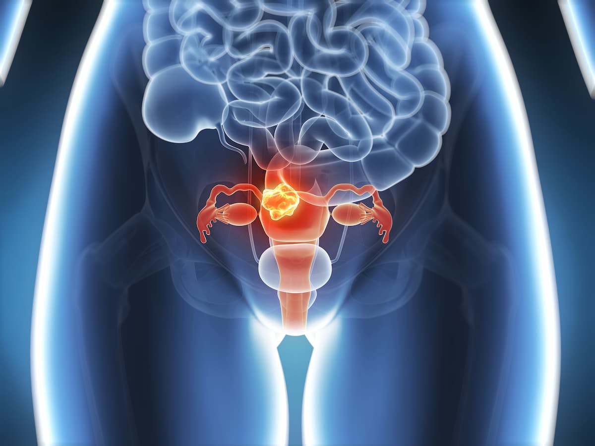 In patients with estrogen receptor–positive recurrent endometrial cancer, letrozole and abemaciclib combination therapy produced an objective response rate of 30% and a median progression-free survival of 9.1 months. 