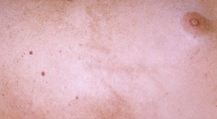 Pruritic Discoloration Following ABVD Therapy