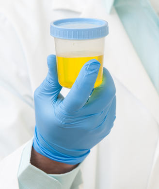 TERT Urine Test Can Help Predict Bladder Cancer Recurrence