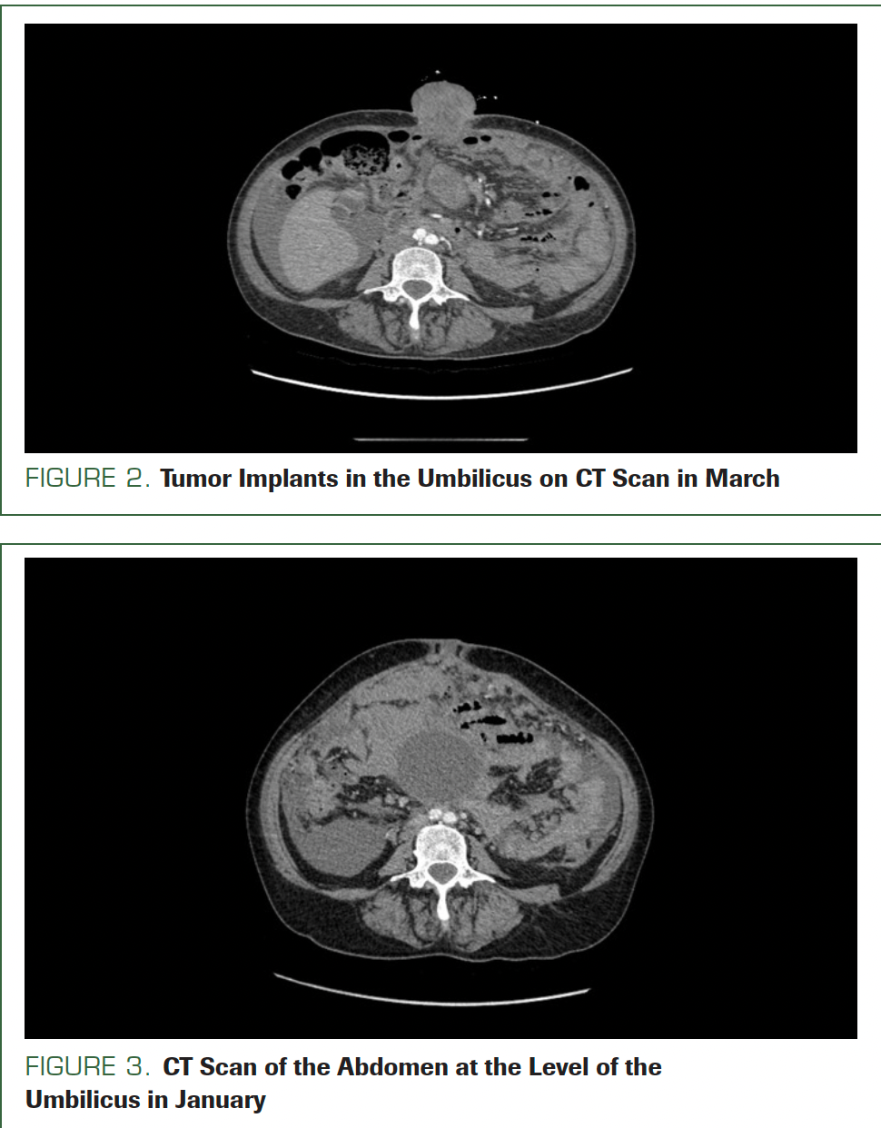 FIGURE 2. Tumor Implants in the Umbilicus on CT Scan in March

FIGURE 3. CT Scan of the Abdomen at the Level of the Umbilicus in January