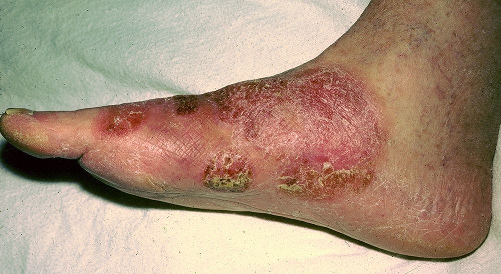 A 51-Year-Old Patient Develops Scaly Plaque on the Right Foot