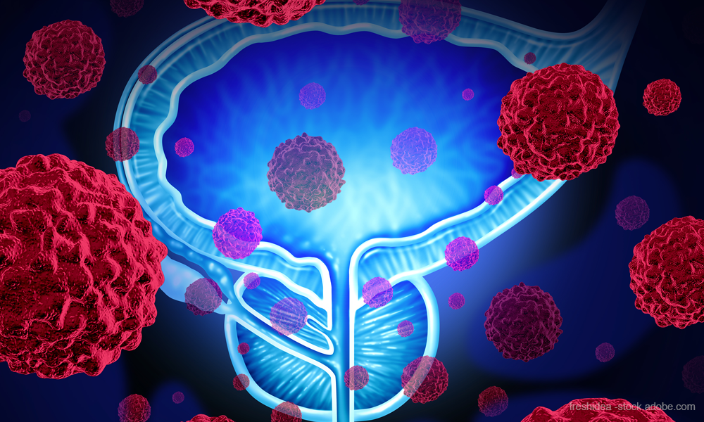Prostate Cancer Genomic Classifier Appears Effective for Improved Patient Outcomes