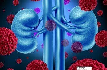 Savolitinib Induces Encouraging Efficacy, Safety in MET-Driven Papillary Renal Cell Carcinoma