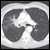 Lung Cancer Trial Shows Survival Benefits in Spiral CT