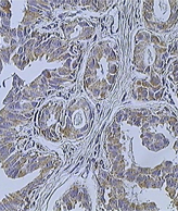 Infiltrating ductal carcinoma of the breast assayed with anti-HER2 antibody. Sou