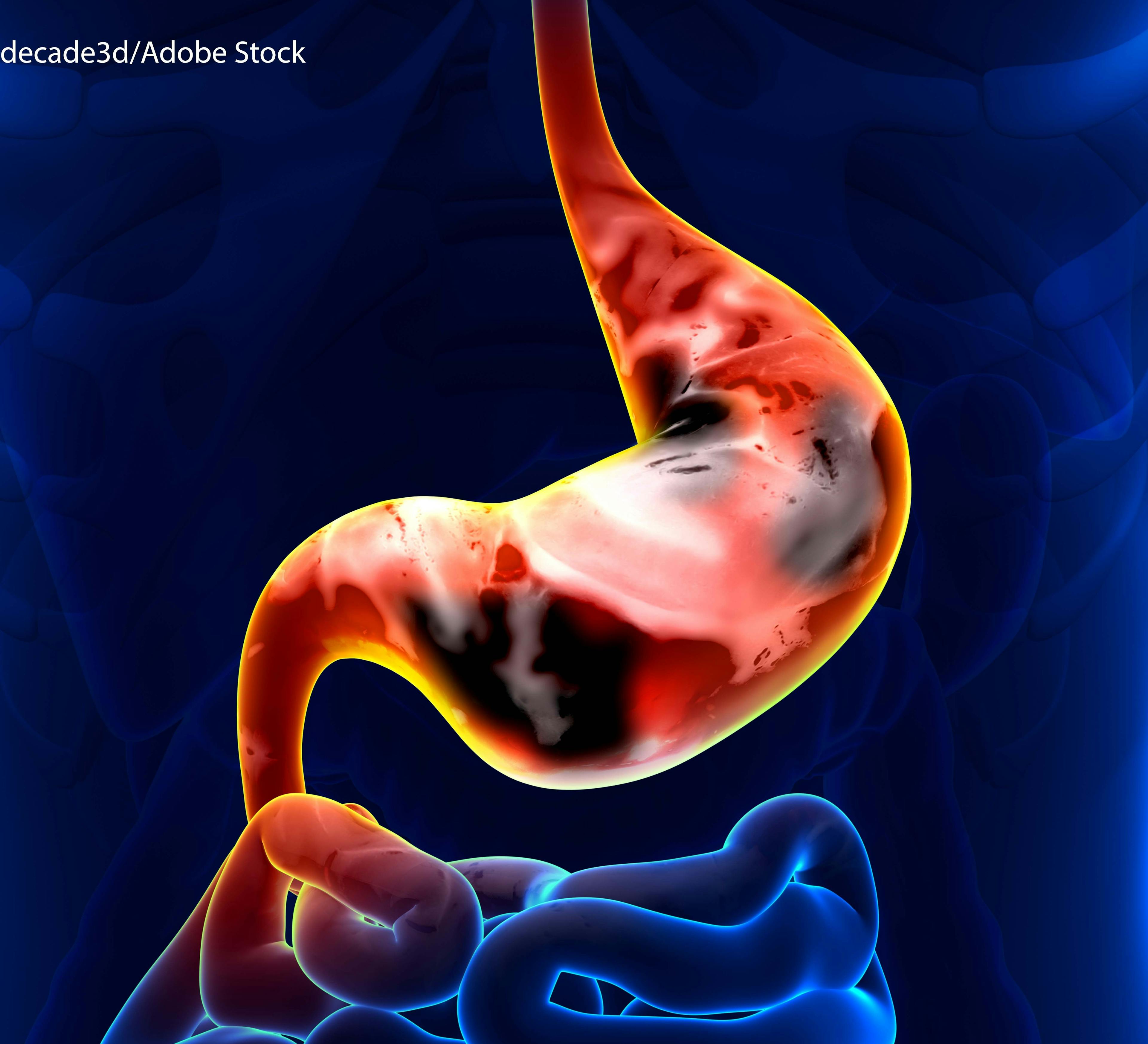 Combo Therapy Shows Modest Survival Gain, More Toxicity for Gastric Cancer